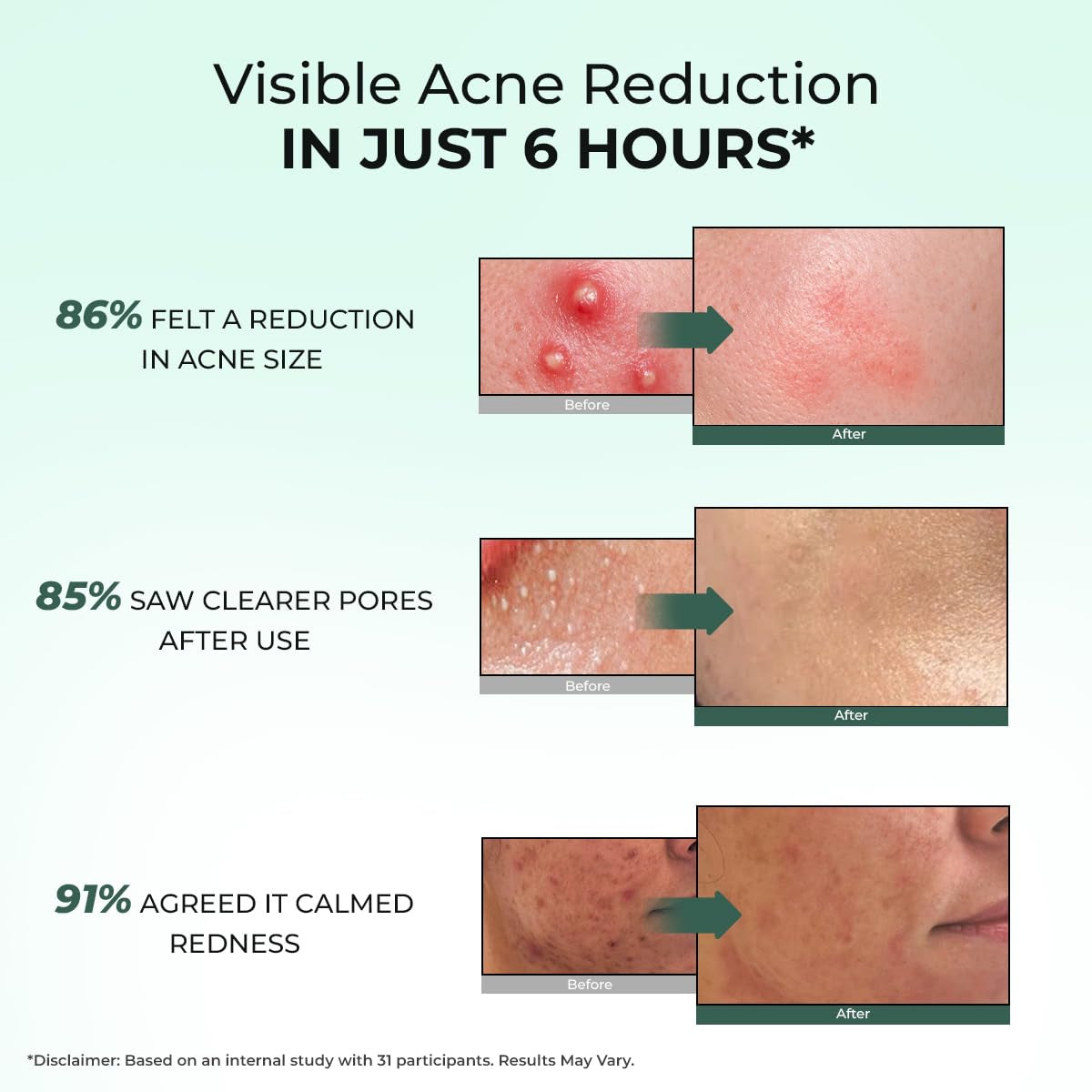 Acne Spot Corrector Gel Serum